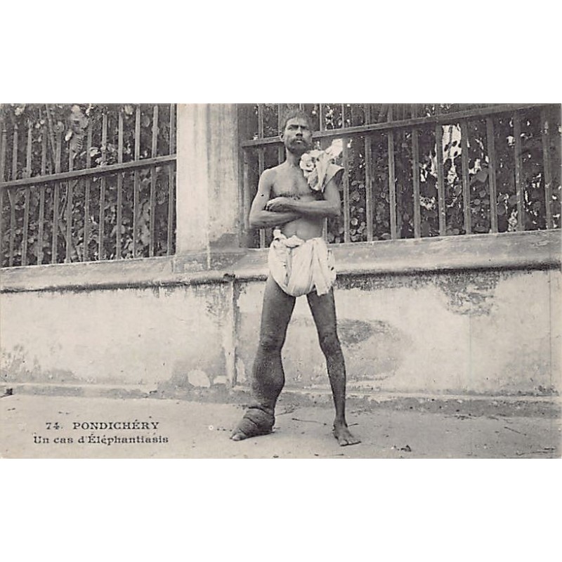 India - PUDUCHERRY Pondichéry - A case of elephanthiasis